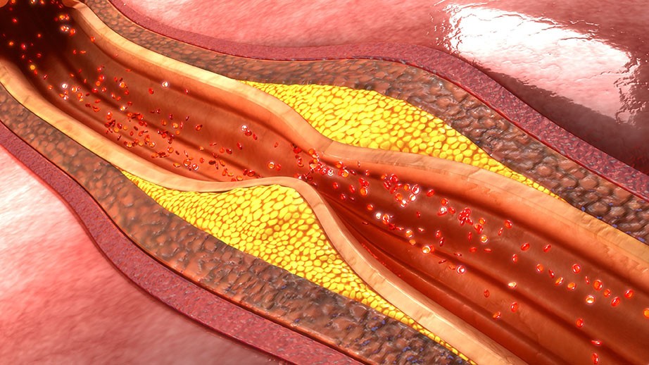 arteroskleroza